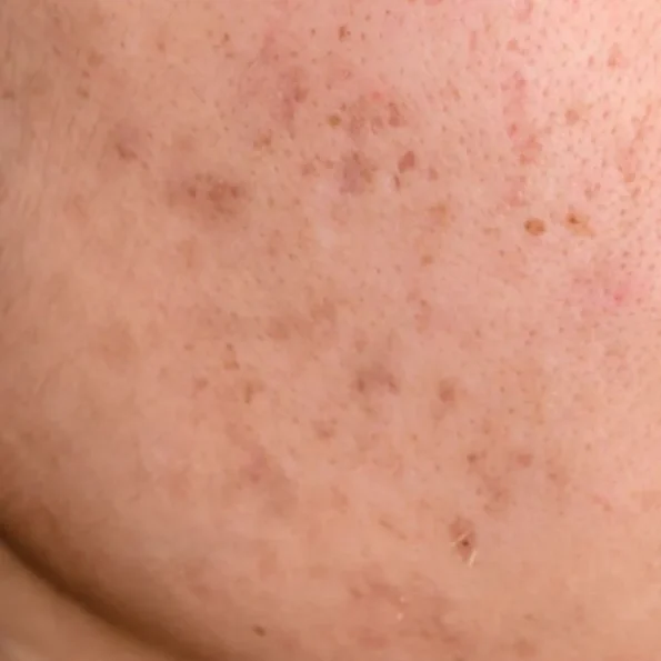 Primer plano de mejilla con hiperpigmentación postinflamatoria y marcas cutáneas
