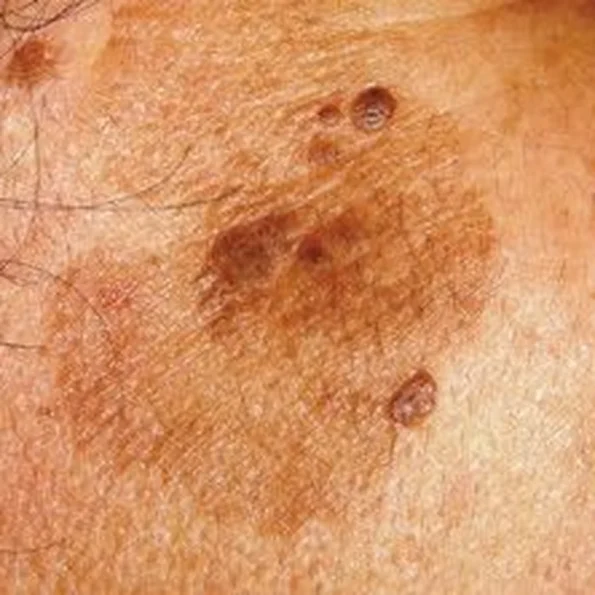 Mancha marrón de hiperpigmentación en la piel del rostro