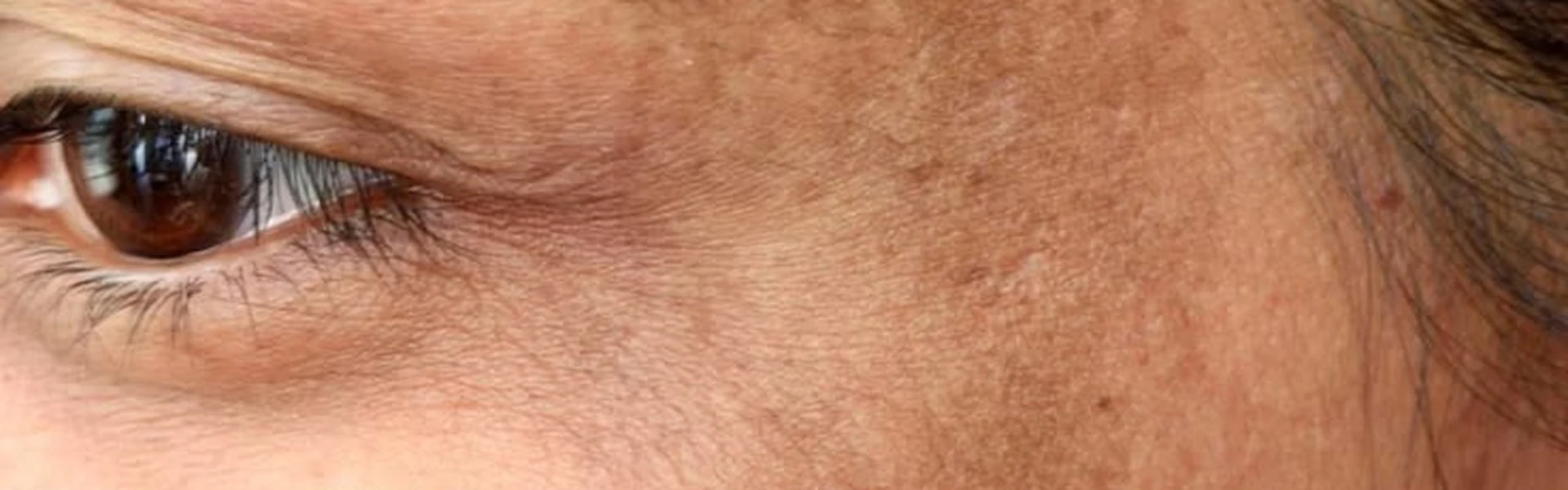 Primer plano de mejilla con manchas faciales e hiperpigmentación