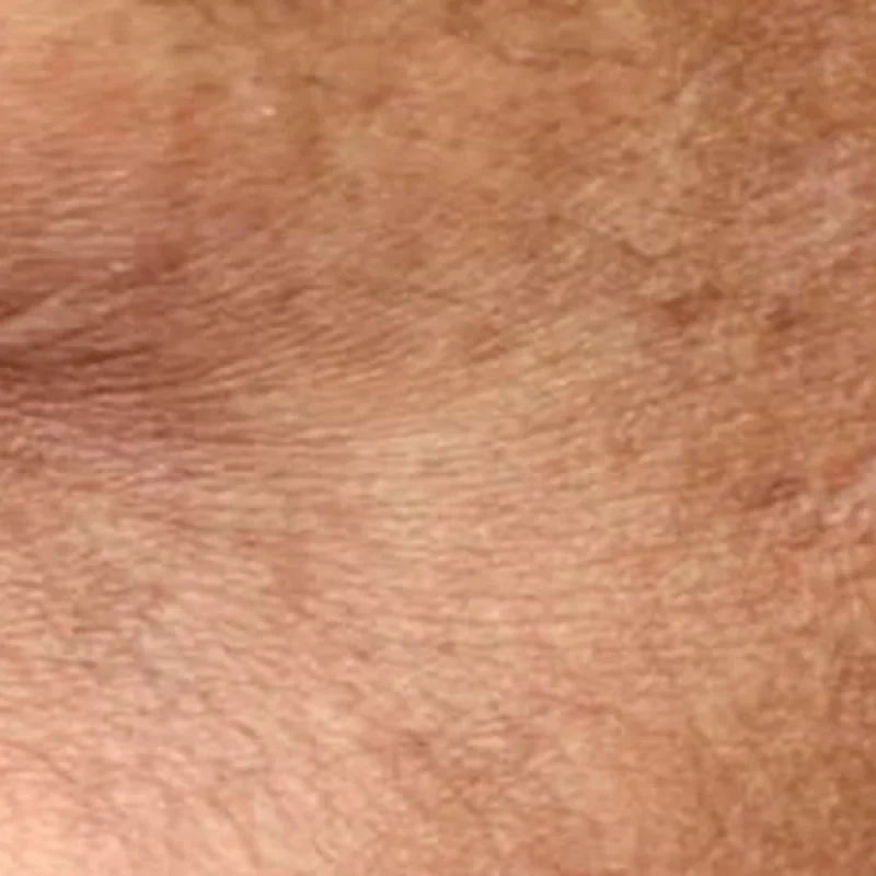 Primer plano de mejilla con manchas faciales e hiperpigmentación